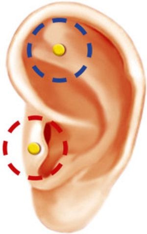 auriculoterapia para enflaquecer resultados copa