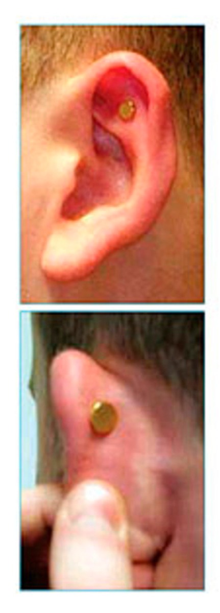 Terapia auricular para adelgazar