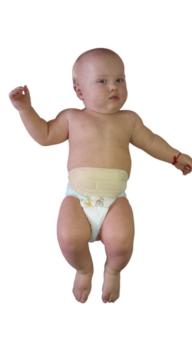 Hernia umbilical en bebes