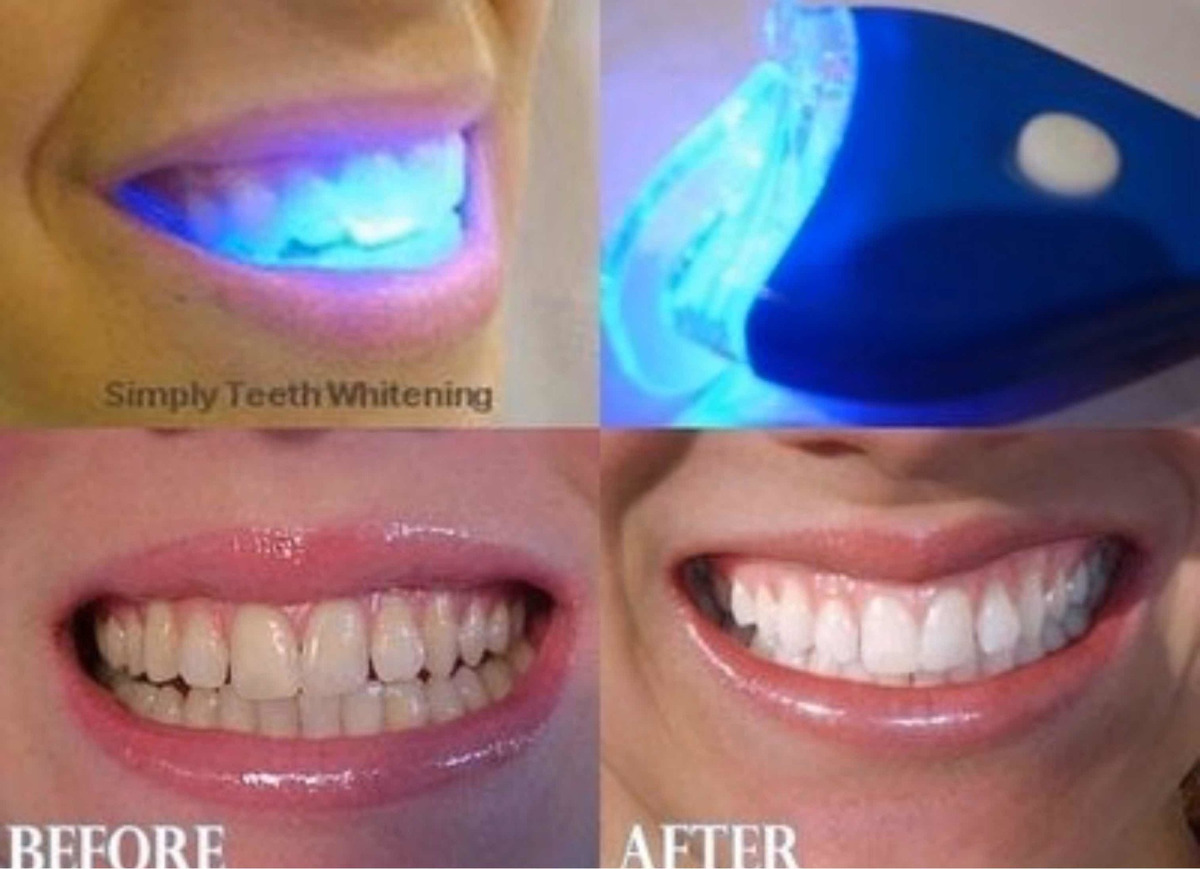 Clareamento dental