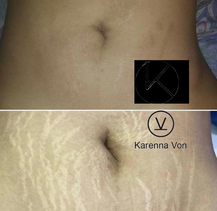 Estrias barriga despues embarazo